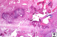 <p>Affects westies aged 4-8 months</p><p>Pathogenesis = autosomal recessive trait</p><ul><li><p>ischaemia = delayed incorporation of blood vessels into femoral head</p></li></ul><p>Gross = fracture and collapse of necrotic trabecular bone, and flattened femoral head</p><p>Histo = subchondral epiphyseal osteonecrosis</p><p></p>