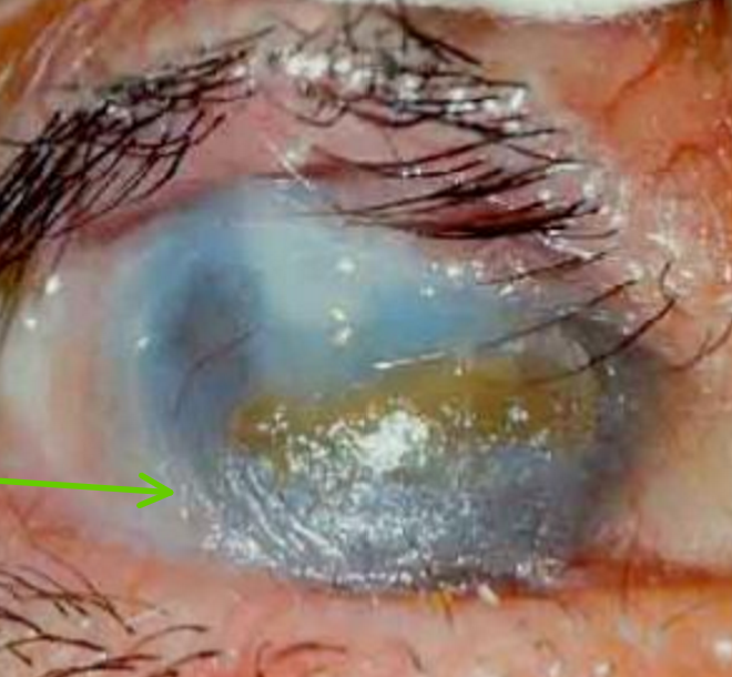 <p>Eyelash condition that is <strong>vision-threatening</strong></p><ul><li><p>20% blindness from cornea scarring</p></li></ul><p></p>