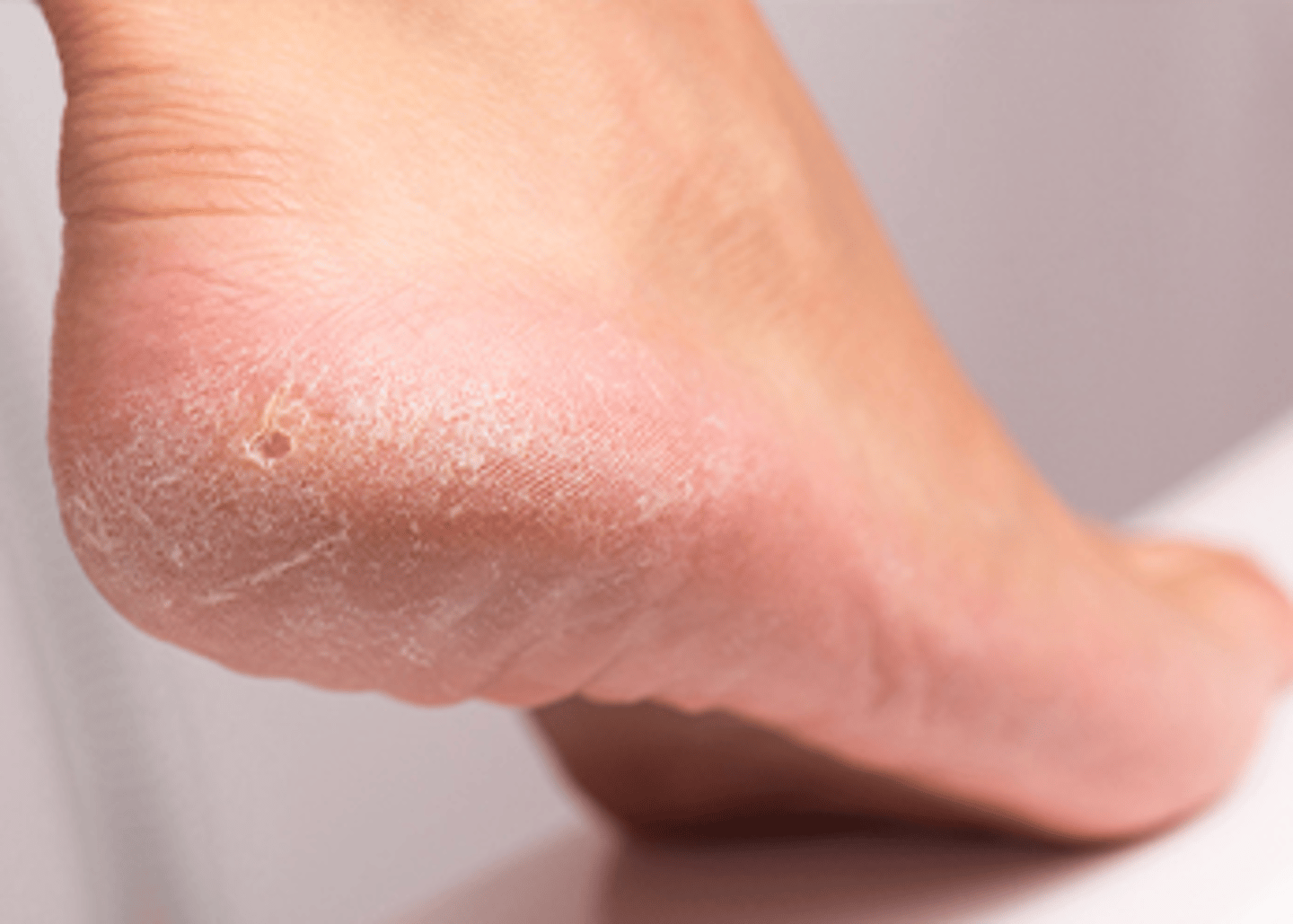 <p>A thickened and hardened part of the skin or soft tissue, especially in an area that has been subjected to friction.</p>