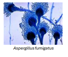 <ul><li><p>immune-mediated reaction <strong>against A. fumigatus</strong> antigens</p></li><li><p><strong><u>Hypersensitivity </u></strong><em>following </em>colonisation of lung - immune mediated </p></li><li><p>ABPA most commonly complicates the course of patients with asthma and cystic fibrosis</p></li><li><p>Cutaneous hypersensitivity to A. fumigatus antigen, <strong>elevated IgE</strong></p></li><li><p><strong>Blood and sputum eosinophilia (overproduction)</strong></p></li><li><p><strong>lower infection →Bronchiectasis (widening of airways, persistent cough, phlegm)</strong></p></li></ul><p></p>