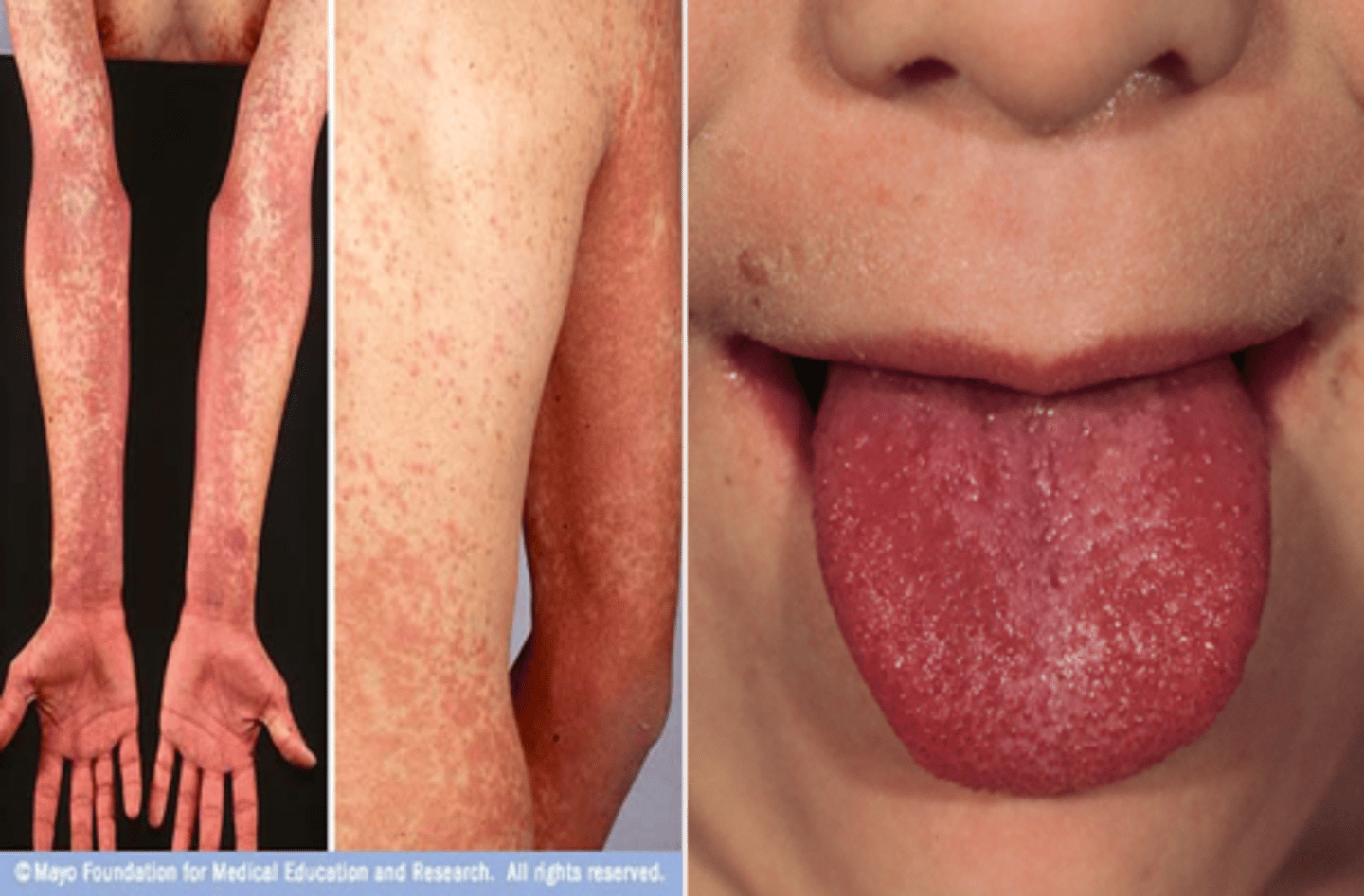 <p>-Disseminated rash (SCARLET!)<br>-Tongue initially with yellow-white coating, which shed and becomes raw (strawberry tongue)</p>