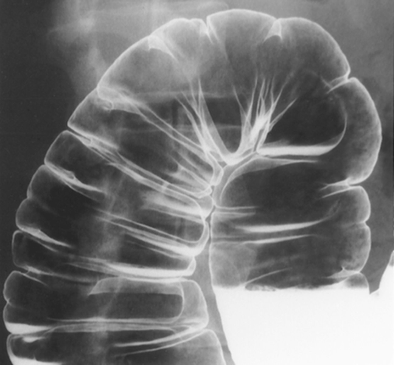 <p>thick, transverse, non-circumferential folds in large bowel with baggy appearance</p>