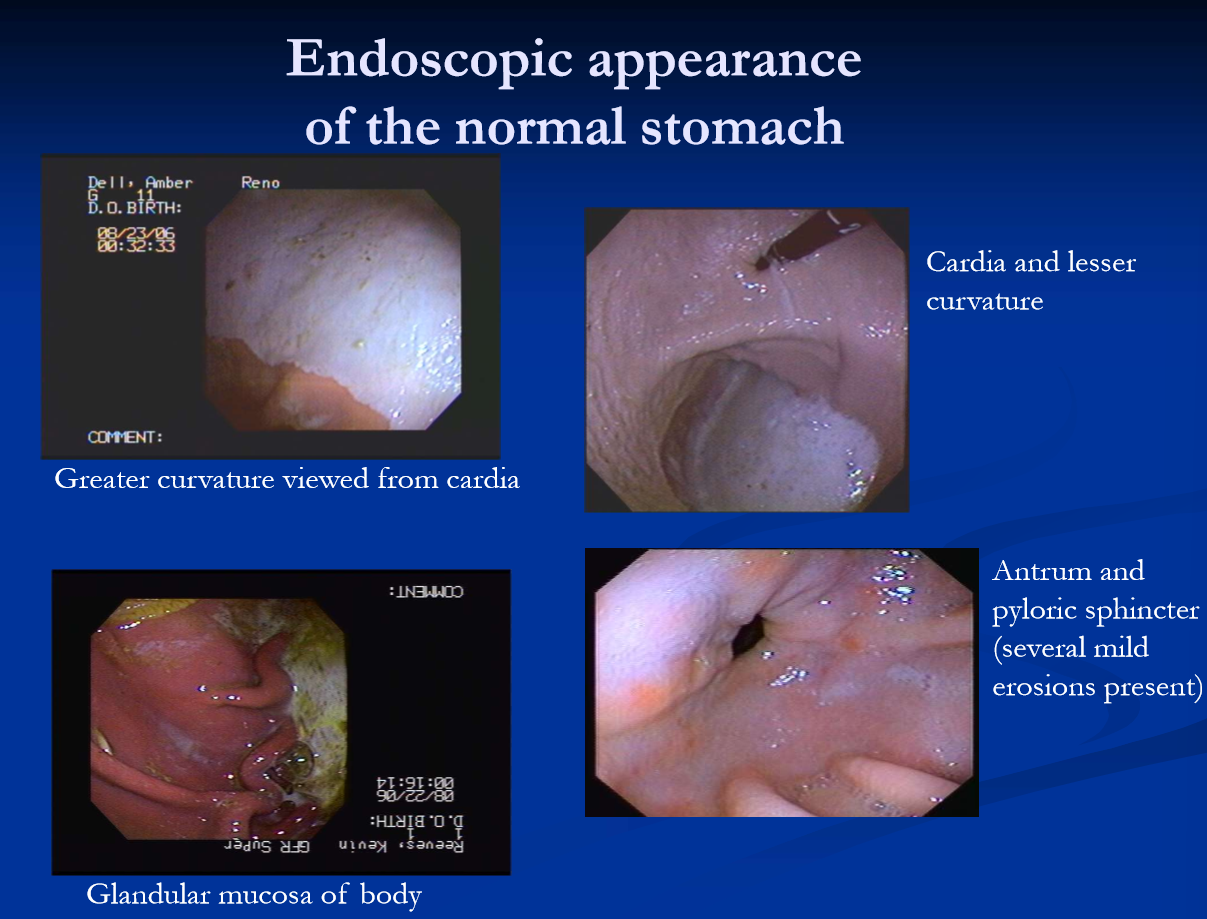<ul><li><p><strong>clinical diagnosis </strong>response to treatment </p><ul><li><p>condition is common, especially in athletes, stressed adn or sick horses, and horses on NSAIDs </p></li></ul></li><li><p><strong>endoscopic examination </strong>of the stomach is definitive (and ideal) </p><ul><li><p>requires 2.5-3m scope </p></li><li><p>graded based on severity </p></li></ul></li></ul><p></p>