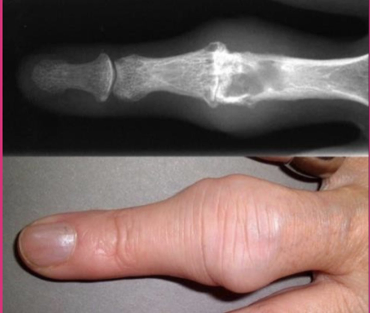 <p>abnormal stiffening and immobility of a joint due to the fusion of the bones</p><p>fusiform inflammation</p>