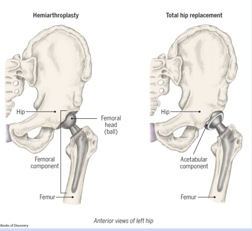 <p>replaces femoral head and acetabulum</p><p>hemiarthroplasty- replaces femoral head</p><p>no hip flexion past 90, no internal rotation, no crossing legs</p>