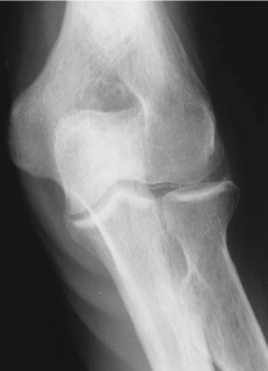 <p>State the clinical features of calcium pyrophosphate dihydrate crystal deposition disease (CCPD)</p>