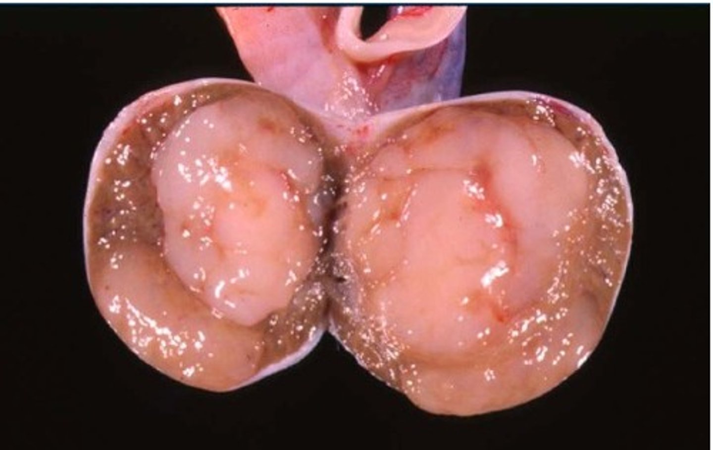 <p>Cream bulging mass</p><p>increase in size of testes, likely unilateral</p>