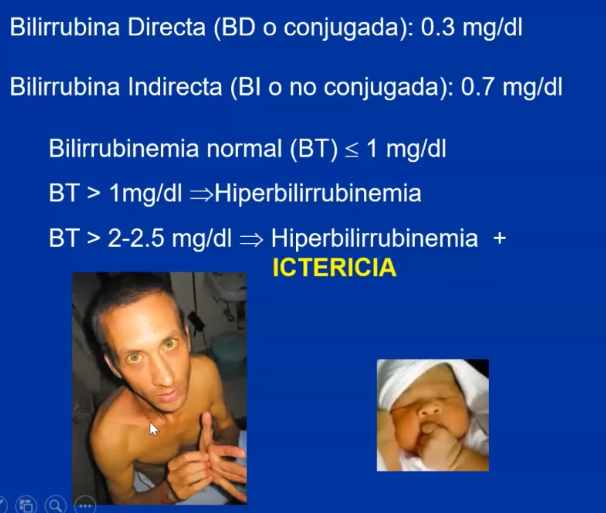 <ul><li><p>+ Cant Bilirrubina indirecta (o no conjugada) en sangre</p></li><li><p>Es normal encontrar una pequeña producción de bilirrubina directa (o conjugada)</p></li></ul><p></p><p>Bilirrubinemia normal total = bilirrubina indirecta + directa (en sangre)</p><p>+1mg/dL = <strong>HIPER</strong>BILIRRUBINEMIA</p><p><span style="color: yellow">+2 - 2.5 mg/dL = <strong>HIPER</strong>BILIRRUBINEMIA + ICTERICIA</span></p><p></p><p><span style="color: yellow">Tipos de ICTERICIA</span></p><ul><li><p>Prehepatica</p></li><li><p>Hepática</p></li><li><p>Post-hepática</p></li></ul><p></p>