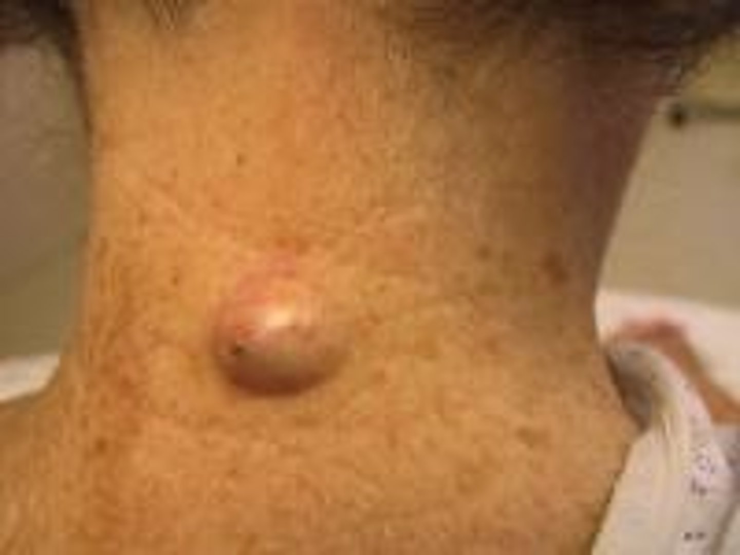 <p>Most common dermal cyst </p><p>Arises from hair follicles </p><p>Contain degenerating keratinocytes, rancid smell when opened </p><p>Mobile nodule w/ overlying punctum </p><p>Must remove in entirety! </p>