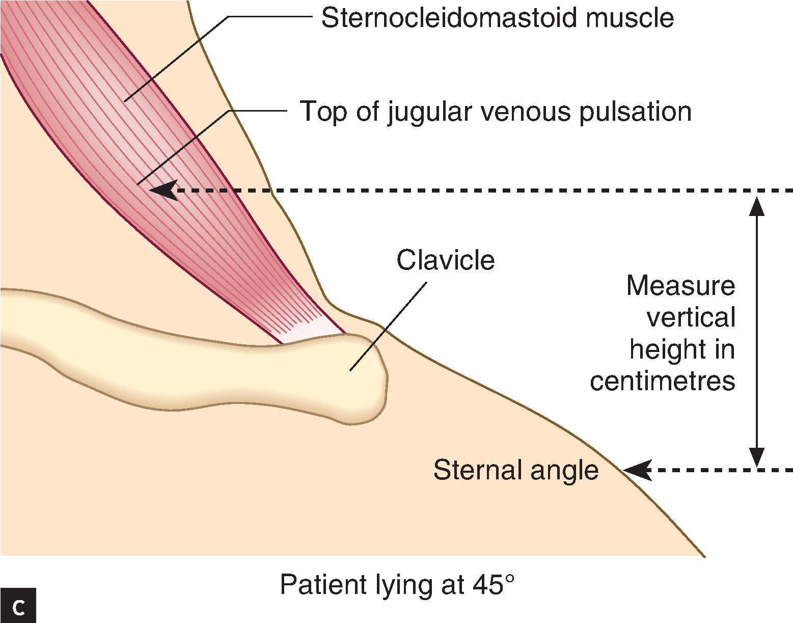 <ul><li><p>patient is positioned at a 45° angle with their head supported on a pillow</p></li><li><p>Ask the patient to turn their head away from you slightly</p></li><li><p>Look at the base of the neck for a double pulsation</p></li><li><p>say: <em>“I’m looking at the base of the neck between the two heads of the sternocleidomastoid”</em></p></li></ul><p>then:</p><ul><li><p>Identify the <strong>highest point of the pulsation</strong> up the <strong>internal jugular vein</strong> and draw an imaginary <strong>horizontal line</strong> across to vertically <strong>above the sternal angle</strong> (<em>Angle of Louis</em>)</p></li><li><p>Measure or estimate the <strong>vertical distance</strong> between this point and the sternal angle</p></li><li><p><strong>A normal JVP height is 3cm or less</strong></p></li></ul><p>then:</p><ul><li><p><strong>abdominojugular reflux test:</strong> </p></li><li><p>ask whether the patient has any abdominal pain</p></li><li><p>compress<span style="font-size: inherit"> over the centre of the abdomen firmly, using the flat of your hand</span></p></li><li><p><span style="font-size: inherit">hold for 10 seconds while watching the JVP</span></p></li><li><p>abdominal pressure increases venous return to the right atrium</p><ul><li><p>it is normal for the JVP to rise transiently</p></li><li><p>should return to normal within a few seconds as the compliance of the right heart and vessels adapts to the increased volume&nbsp;</p></li></ul></li><li><p><strong>A positive (bad) test is when the JVP remains elevated at &gt; 4 cm for the full 10 seconds that you maintain pressure</strong></p></li></ul><p></p>