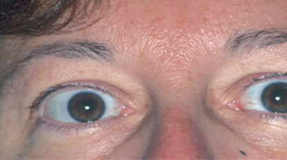 <p>Protruding Eyes</p>
