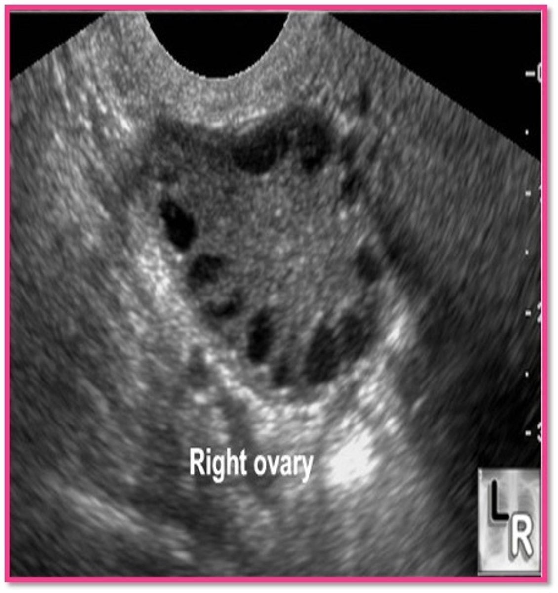 <p>- normal or enlarged ovaries</p><p>- string of pearls</p>