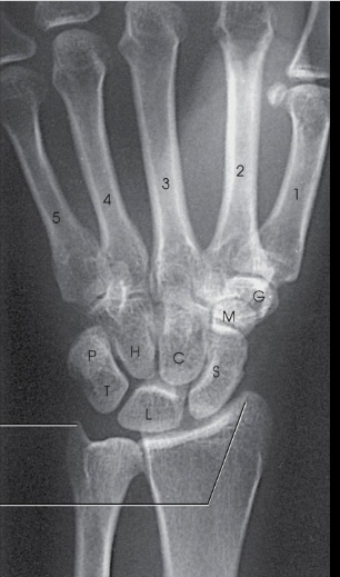 <p>What carpal bone is M?</p>