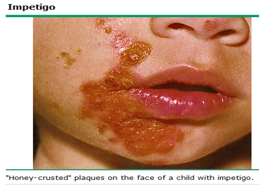 <p>honey crusted plaques that spreads first to/from the nose; highly contagious; most common ages 2-5</p>