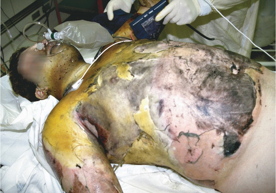 <ul><li><p><span><span>All layers of skin burned</span></span></p></li><li><p><span><span>Blackened areas or dry and white patches</span></span></p><ul><li><p><span><span>May not have pain at all, or may only be at the periphery. (Why)</span></span></p></li></ul></li></ul><p></p>