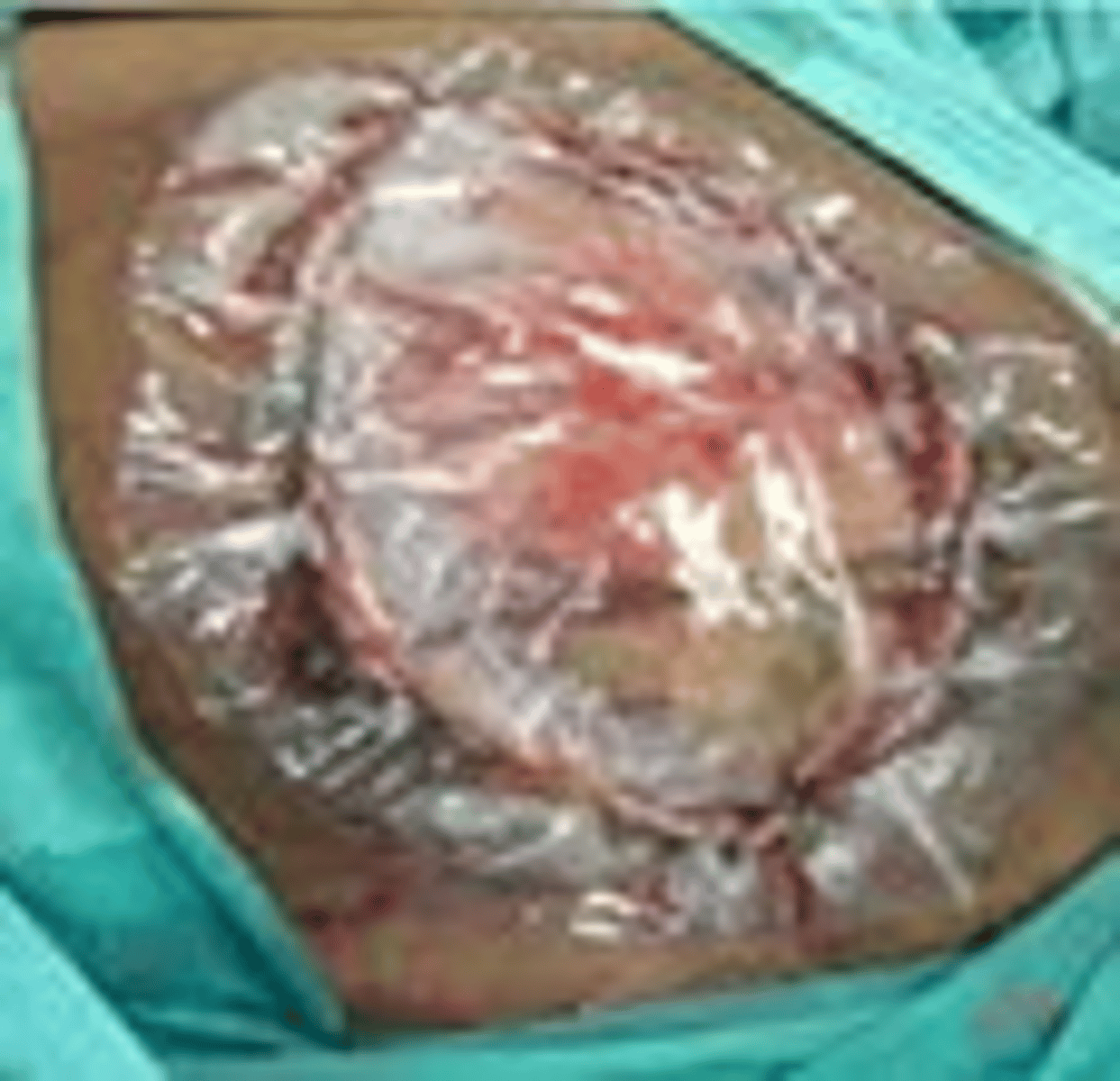 <p>Second-Look Laparotomy (28% require further resection)</p><p>Looking for color, distension, peristalsis, or bleeding </p><p>(FYI keep abdomen open if anticipating this during 1st surgery)</p>