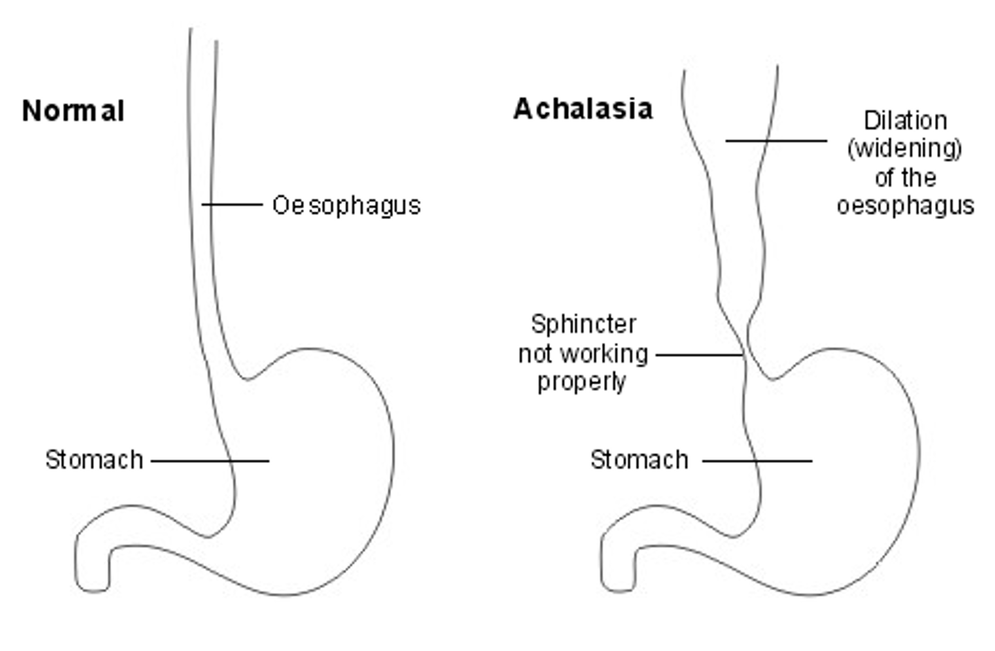 <p>Motor disorder of the esophagus characterized by impaired relaxation of the lower esophageal sphincter (LES) and loss of peristalsis in the distal 2/3 of the esophagus</p><p>[Lack of VIP]</p>