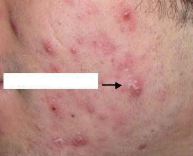 <p>what type of lesion is depicted</p>