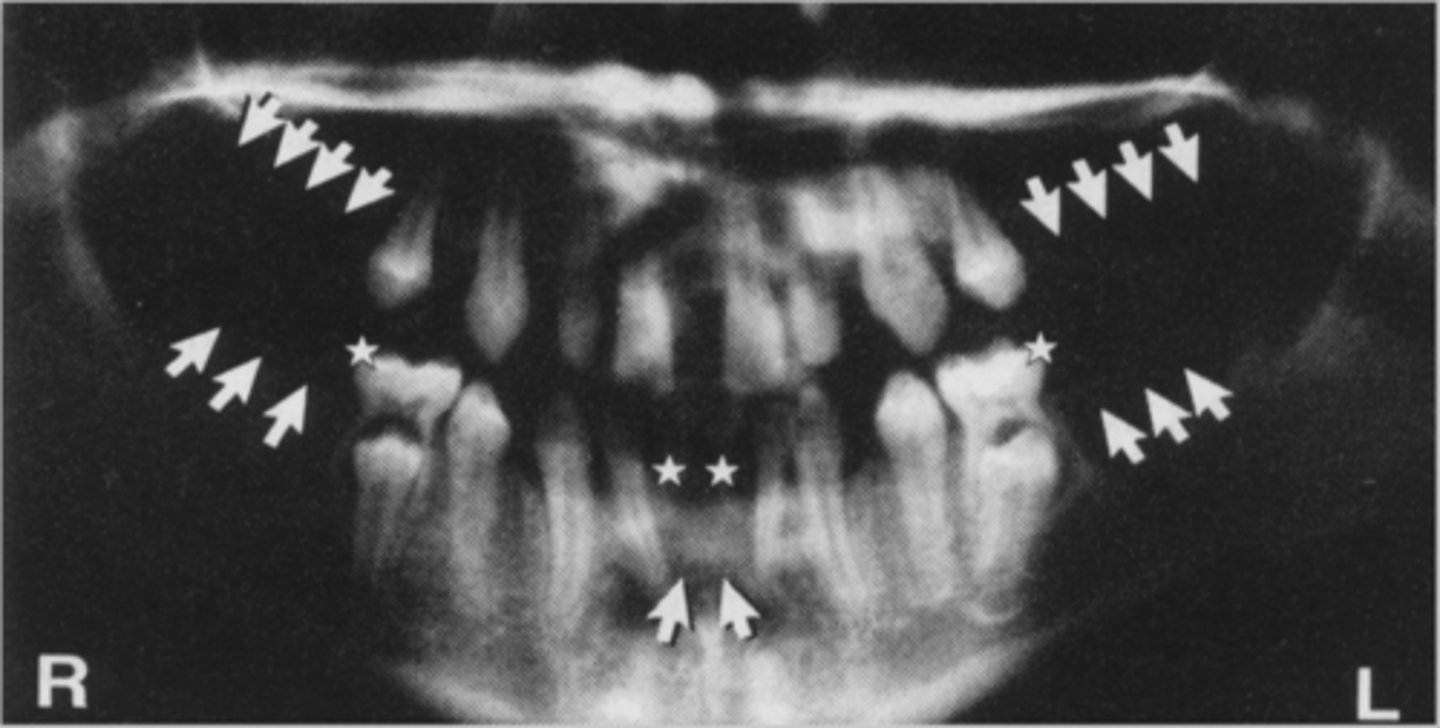 <p>Congenitally missing 6 teeth or more (3rd molars are common)</p><p>-Occurs during development</p>