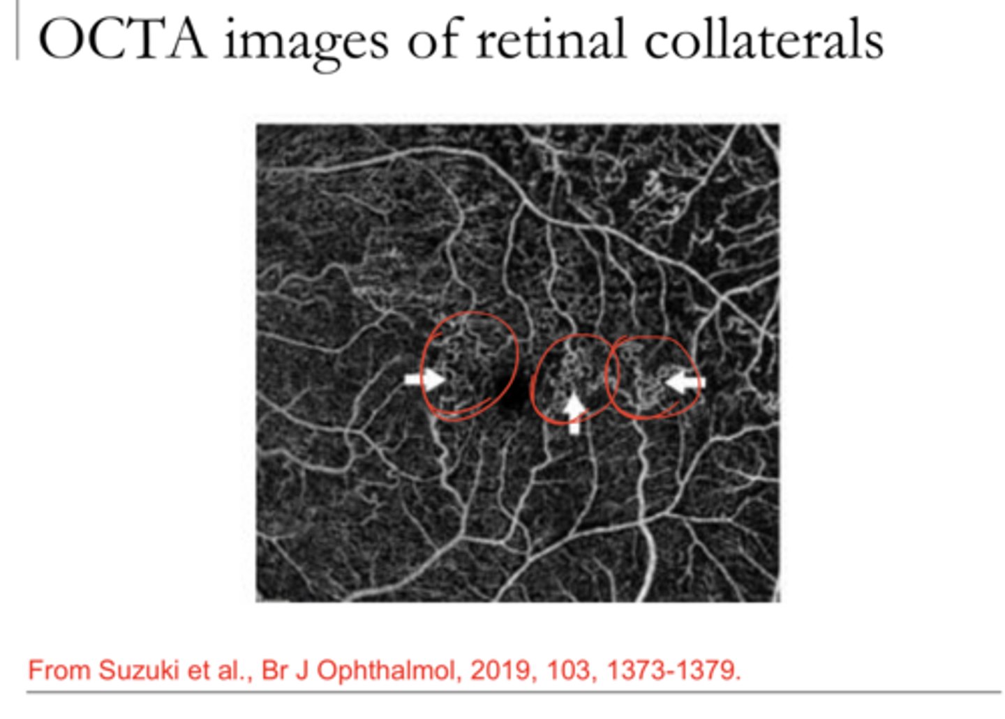 <p>OCT-A images of retinal collaterals (Pic)</p>