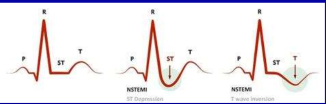 <ul><li><p><strong>ST depression</strong></p></li><li><p>T wave inversion</p></li></ul>