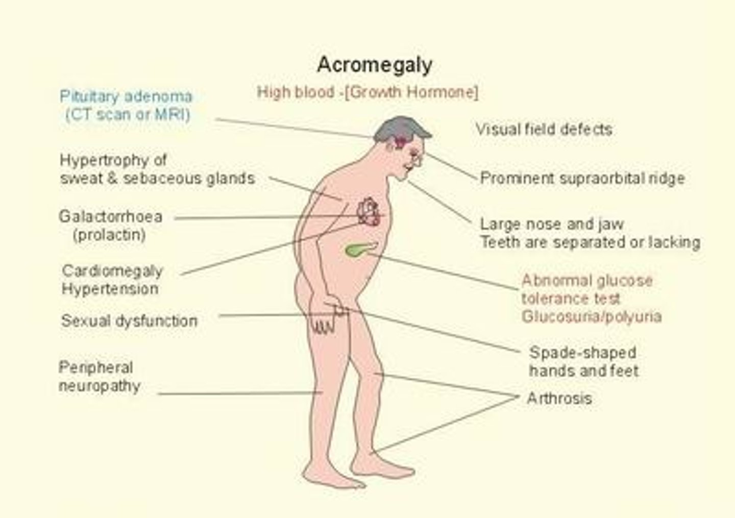 <p>Rare condition resulting from excess secretion of growth hormone (GH), causing body tissues and bone to grow more quickly</p>