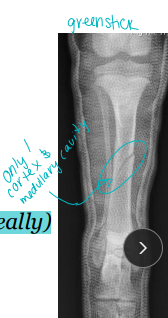 <ul><li><p><span style="background-color: transparent;"><strong><span>Considerations: </span></strong><u><span>Common</span></u><span>, Min soft tissue envelope, </span><strong><span>risk of open fracture</span></strong></span></p><ul><li><p>fibula broke concurrently, not broke in young </p></li></ul></li><li><p><span style="background-color: transparent;"><strong><span>Tx:</span></strong></span></p><ul><li><p><span style="background-color: transparent;"><strong><span>Rx: </span></strong><span>Casting/splinting </span></span></p><ul><li><p><span style="background-color: transparent;"><u><span>closed</span></u><span>, </span><u><span>transverse fractures</span></u><span>, >50% reduction, lateral splint (greenstick fractures)</span></span></p></li></ul></li><li><p><span style="background-color: transparent;"><strong><span>Sx: </span></strong><span>Plate + screws, IM pin + cerclage, Interlocking nail, ESF</span></span></p><ul><li><p><span style="background-color: transparent;"><strong><span>Avulsion: </span></strong><span>tension band + K-wire, or K-wires alone</span></span></p></li><li><p><span style="background-color: transparent;"><strong><span>Physeal: </span></strong><span>urgent fixation, cross pins</span></span></p><ul><li><p>younger animals</p></li></ul></li></ul></li></ul></li></ul><p></p>