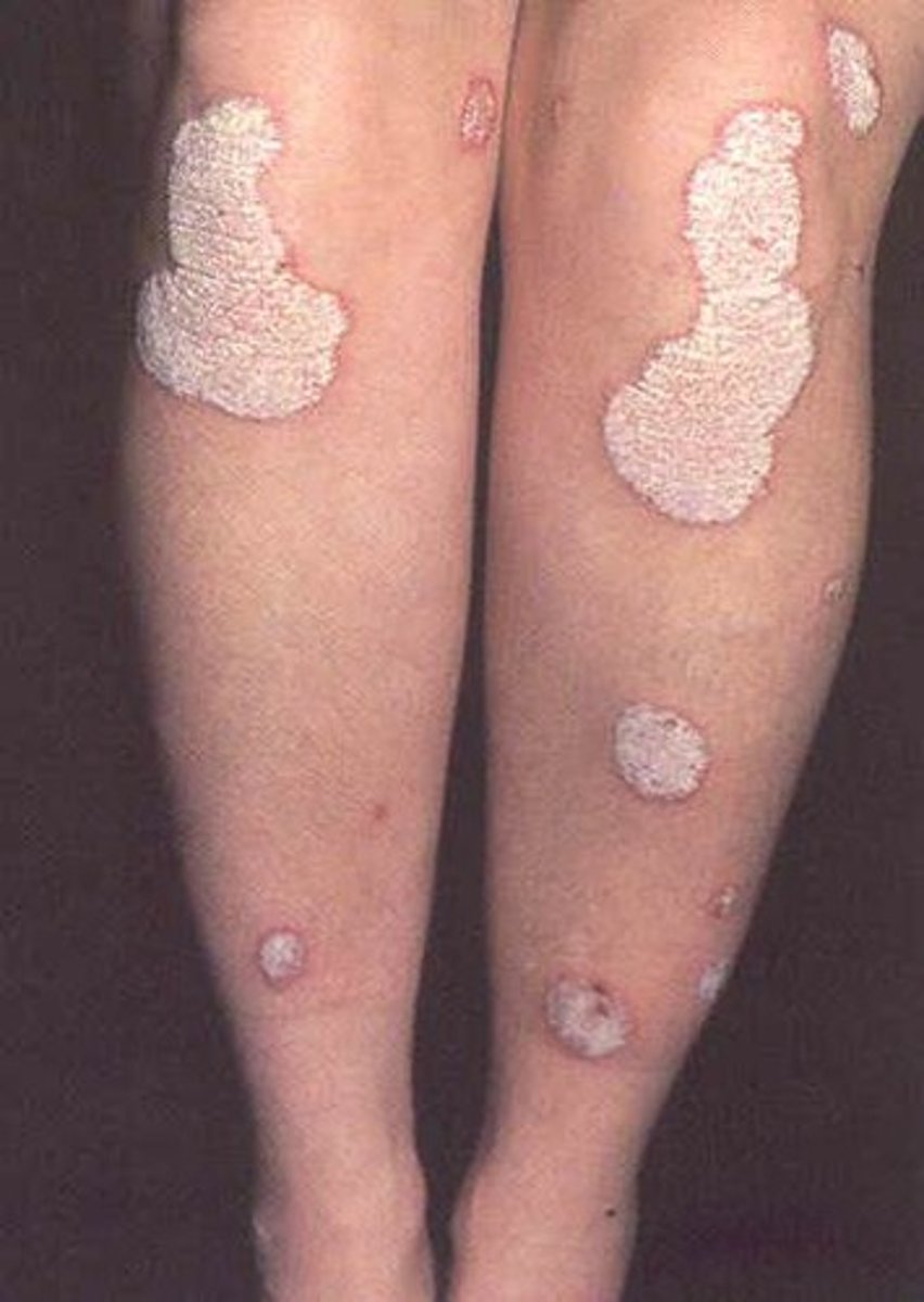 <p>diagnose this image:</p><p>this usually presents as 1-10 cm erythematous, sharply, defined, and raised w/ thick, silvery scale</p>
