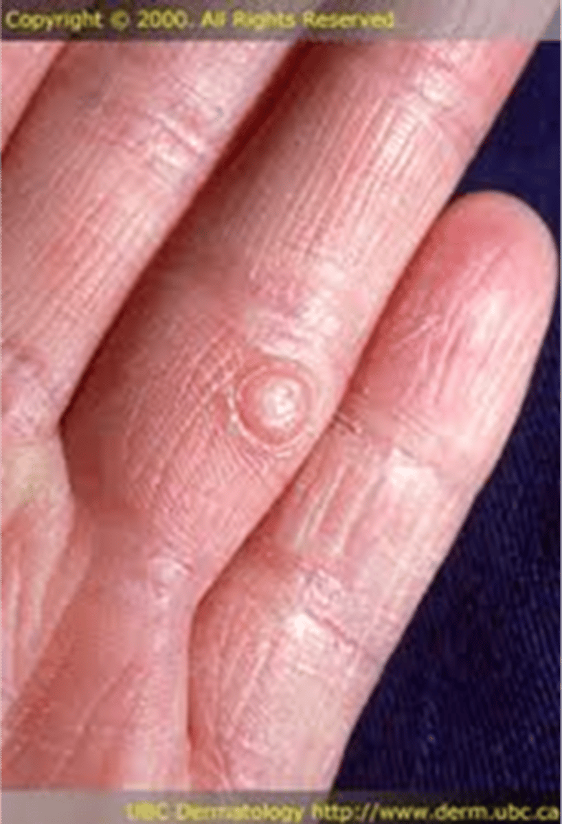 <p>____________________:</p><p>• Superficial, solid lesion</p><p>• &lt;0.5 cm in diameter</p><p>• Often occur in clusters</p><p>• Can accompany rashes</p>