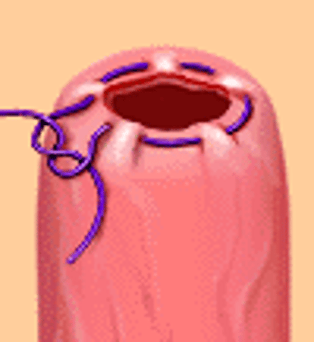 <p>Purse-string</p>
