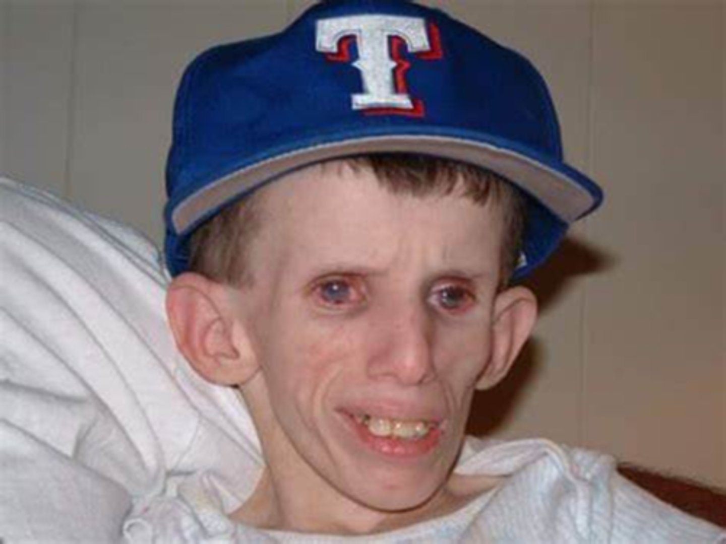 <p>What are the main features of <strong>Cockayne syndrome</strong>?</p>