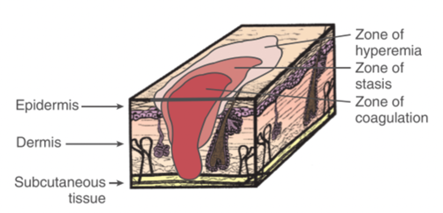 <p>The area surrounding the zone of stasis that presents with inflammation, but will fully recover without any intervention or permanent damage</p>