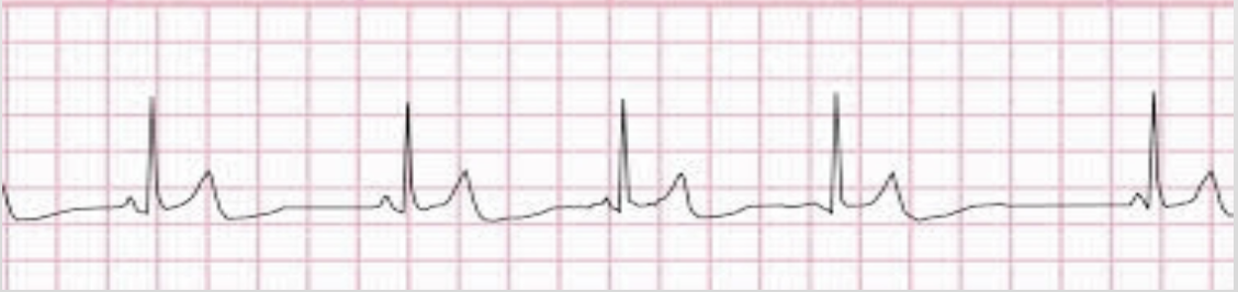 <p>pacemaker site shifts → at least 3 different P wave morphologies </p>