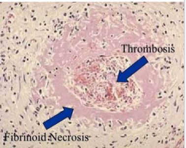 <p>Fibrinoid necrosis</p>