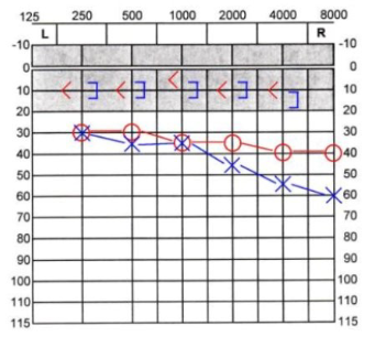 <ul><li><p>The difference between the air and the bone conduction thresholds.</p></li><li><p>The gap should be 10 dB or less in subjects without a conductive component (sensorineural hearing loss or normal hearing).</p></li></ul><p>“Right mild flat conductive hearing loss”</p>