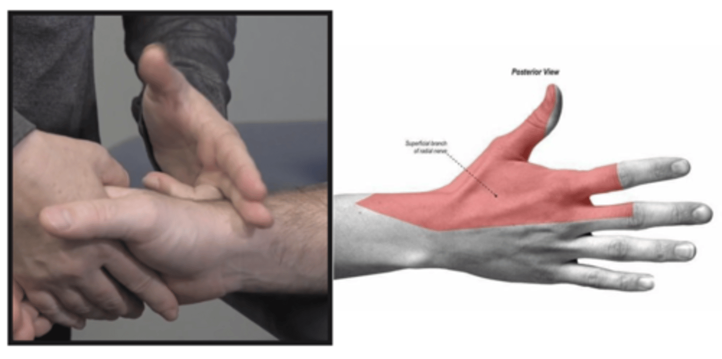 <p>Assess for Superficial radial nerve palsy; + test: tenderness and paresthesia</p>
