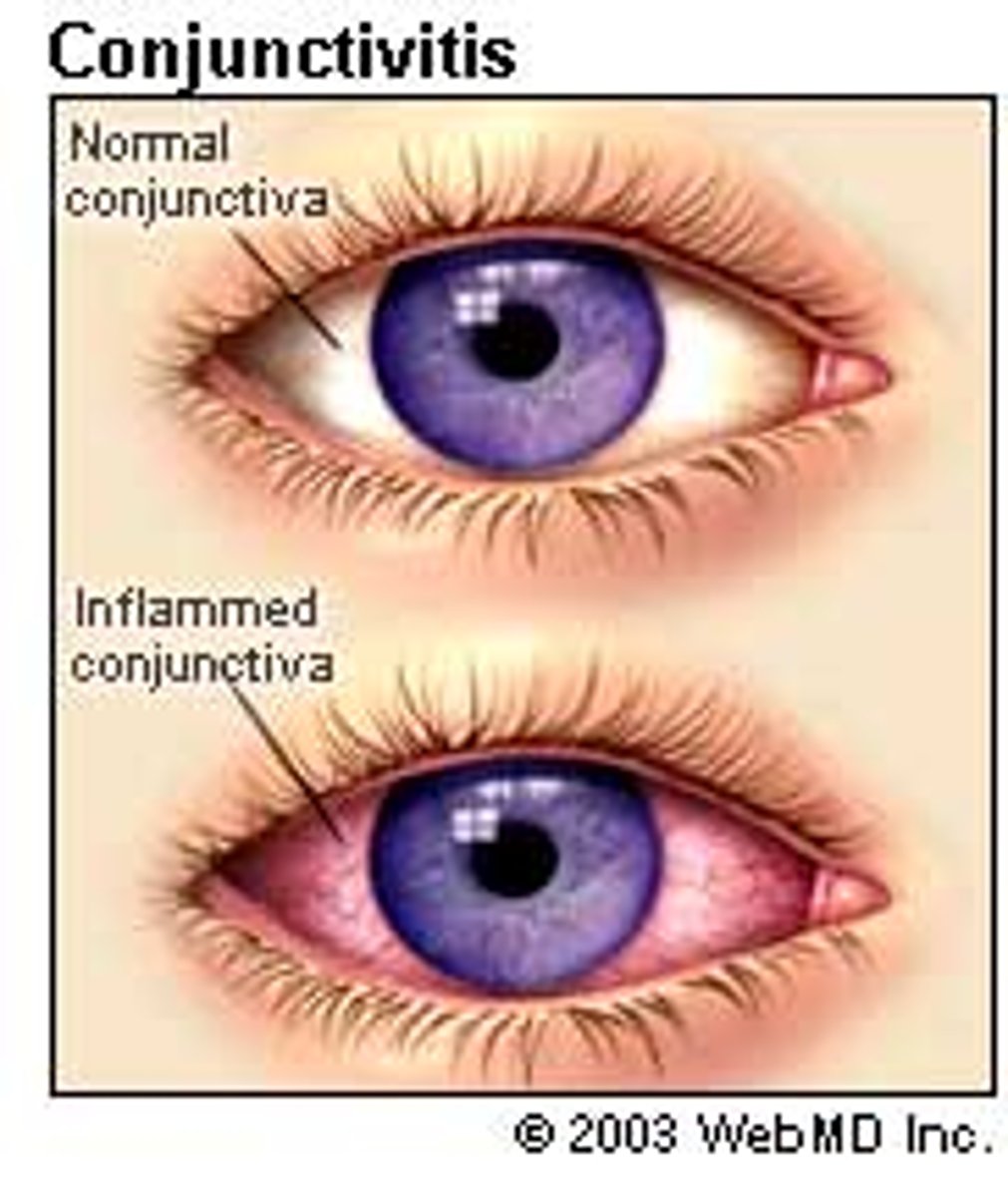 <p>An inflammation of the conjunctiva, also called red eye or pinkeye</p>