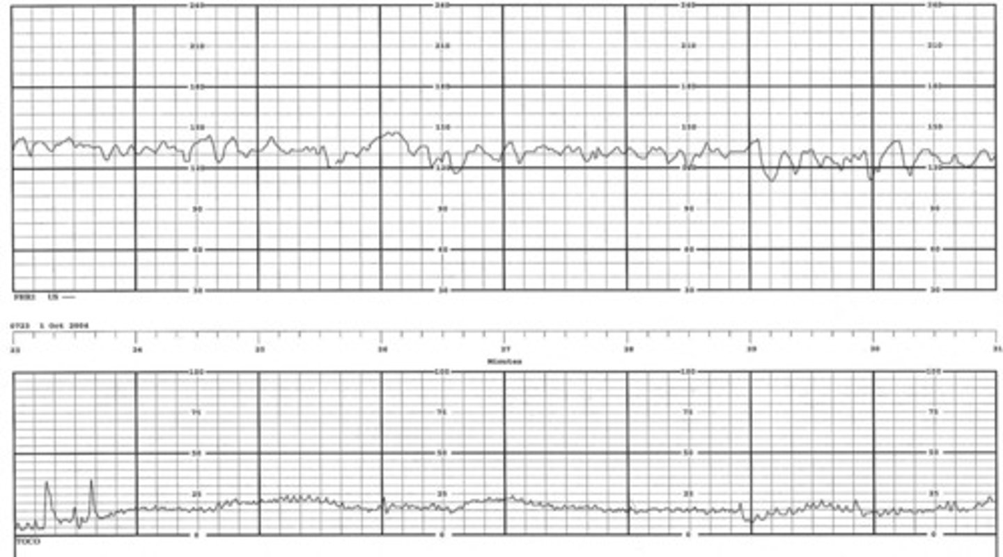 <p>-6-25 bpm</p><p>-normal (reassuring) and indicates that fetus is well oxygenated</p>