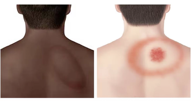 <ul><li><p>Fever, chills, headache, fatigue, muscle and joint aches</p></li><li><p>Swollen lymph nodes</p></li><li><p>ERYTHEMA MIGRANS (EM) RASH → Looks like a bullseye</p></li></ul><p></p>