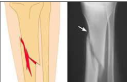 <p>What type of fracture is this?</p>