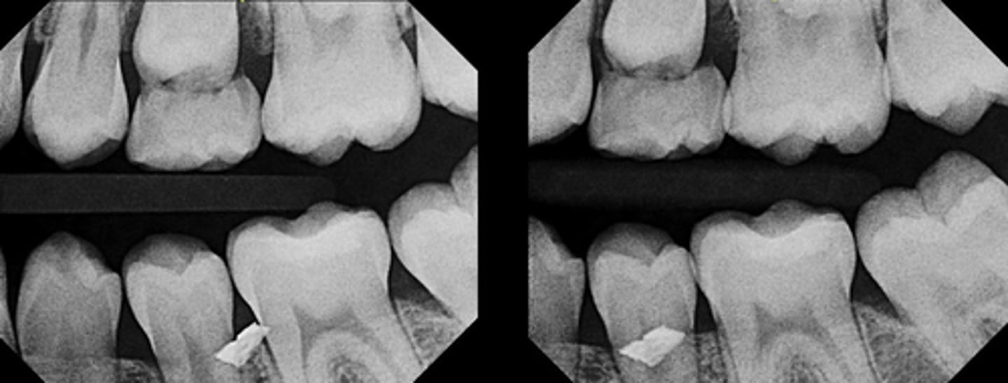 <p>Is this foreign object lingual or buccal to the teeth?</p>
