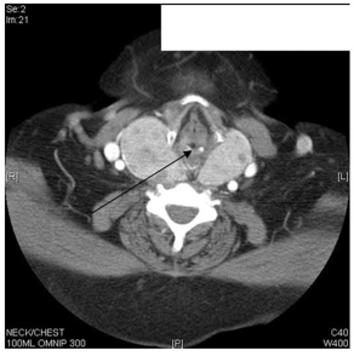 <p>patient presents with the following CT. What is the diagnosis?</p>