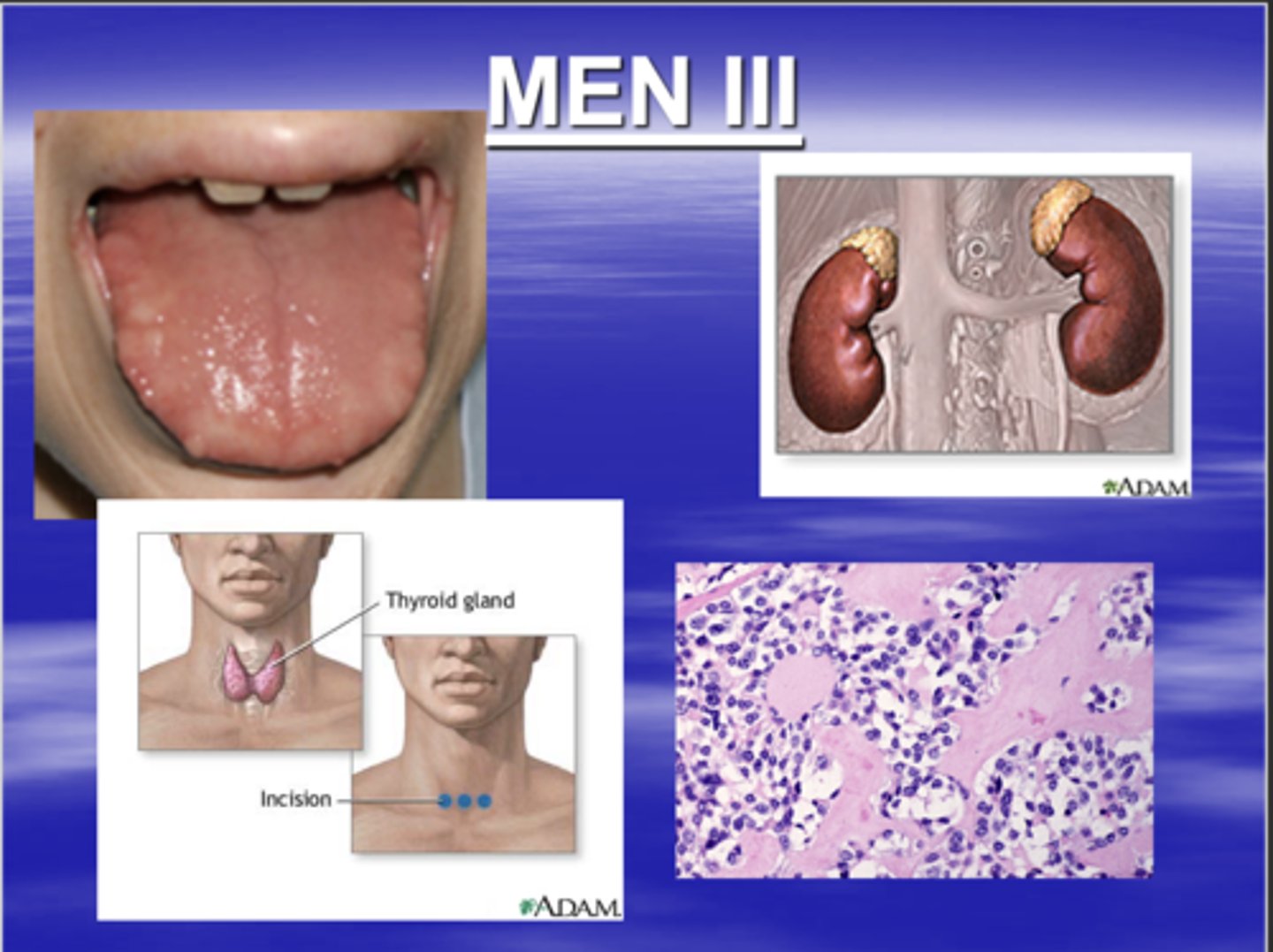 <p>characterized by:</p><p>1. multiple neuromas</p><p>2. pheochromocytoma </p><p>3. medullary carcinoma of the thyroid </p><p>you can save a patients life if you detect this </p>