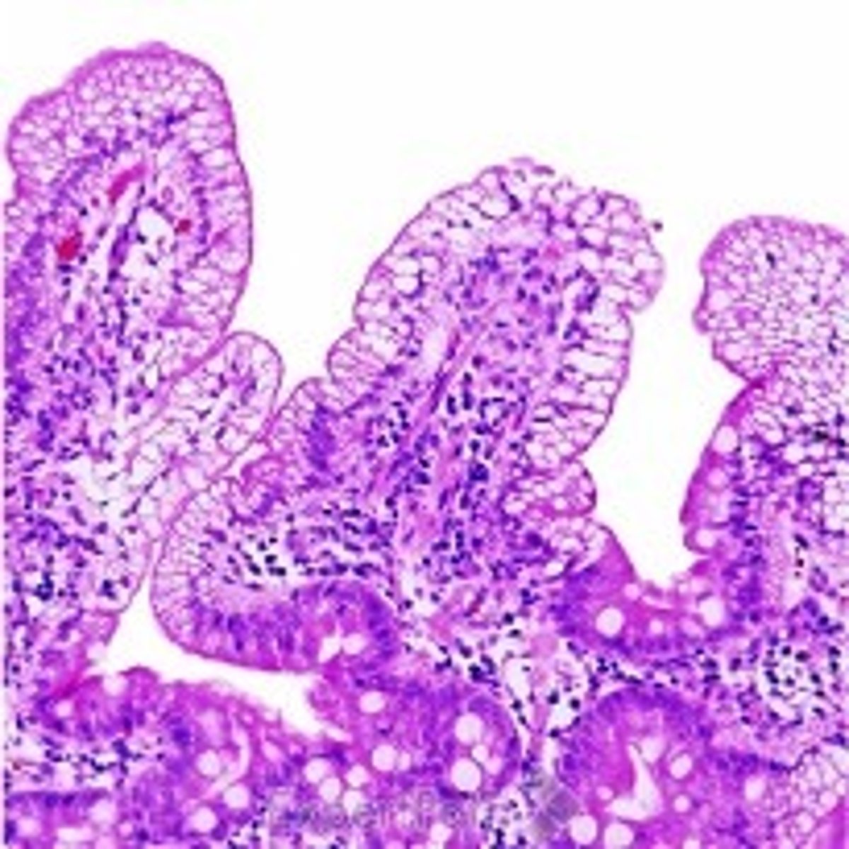 <p>Define Condition:</p><p>TRANSEPITHELIAL Transport defect d/t Autosomal recessive deficiency of apolipoprotein B-48 &amp; B-100 (for synthesis and export of chylomicrons and VLDL, respectively)</p><p>-Path: Mutation in the microsomal triglyceride transfer protein in the small intestine -&gt; failure to properly export lipids into blood -&gt; build-up of lipids in enterocytes which appear as lipid-filled vacuoles and fat malabsorption</p><p>-Sx/PE: (presents in Infancy)</p><p>&gt; FTV</p><p>&gt; Diarrhea</p><p>&gt; Steatorrhea</p><p>&gt; Fat Soluble Vitamin Deficiency (ADEK)</p><p>&gt;&gt; Night Blindness = A</p><p>&gt;&gt; Osteopenia = D</p><p>&gt;&gt; Coagulopathy = K</p><p>-Dx:</p><p>&gt; Biopsy:</p><p>&gt;&gt; Vacuoles of fat in villia</p><p>&gt; Blood Smear:</p><p>&gt;&gt; Acanthocytes (50% or more red blood cells) in peripheral blood d/t lipid plasma membrane defects</p>