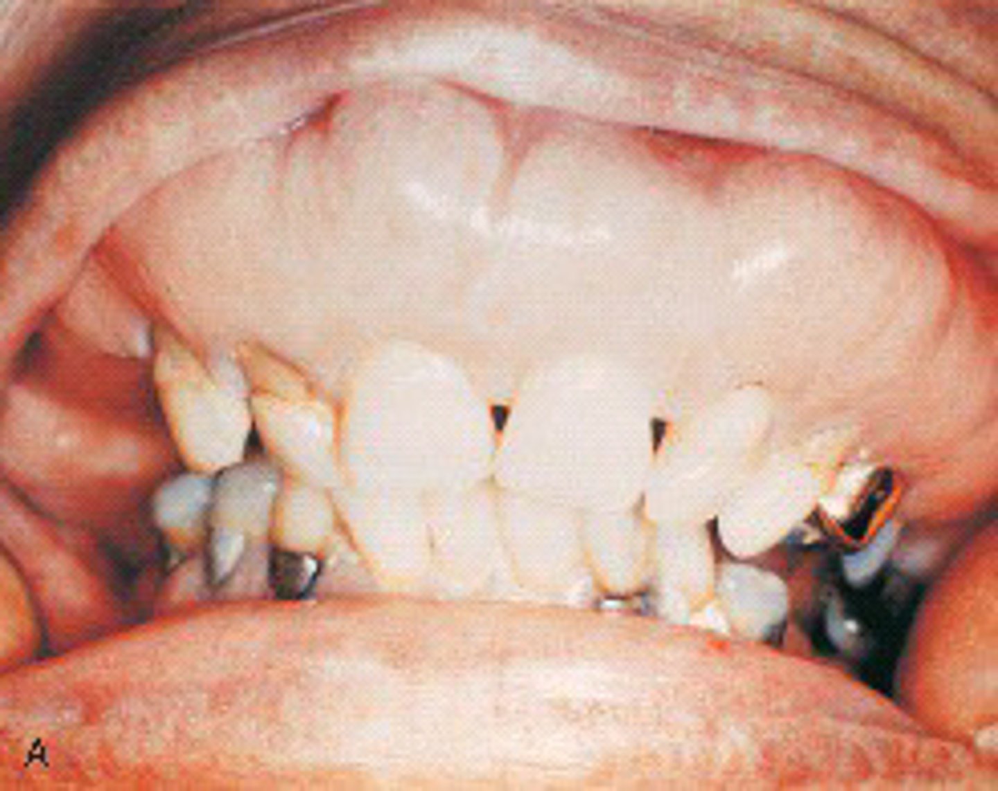 <p>b.Paget disease of bone</p>