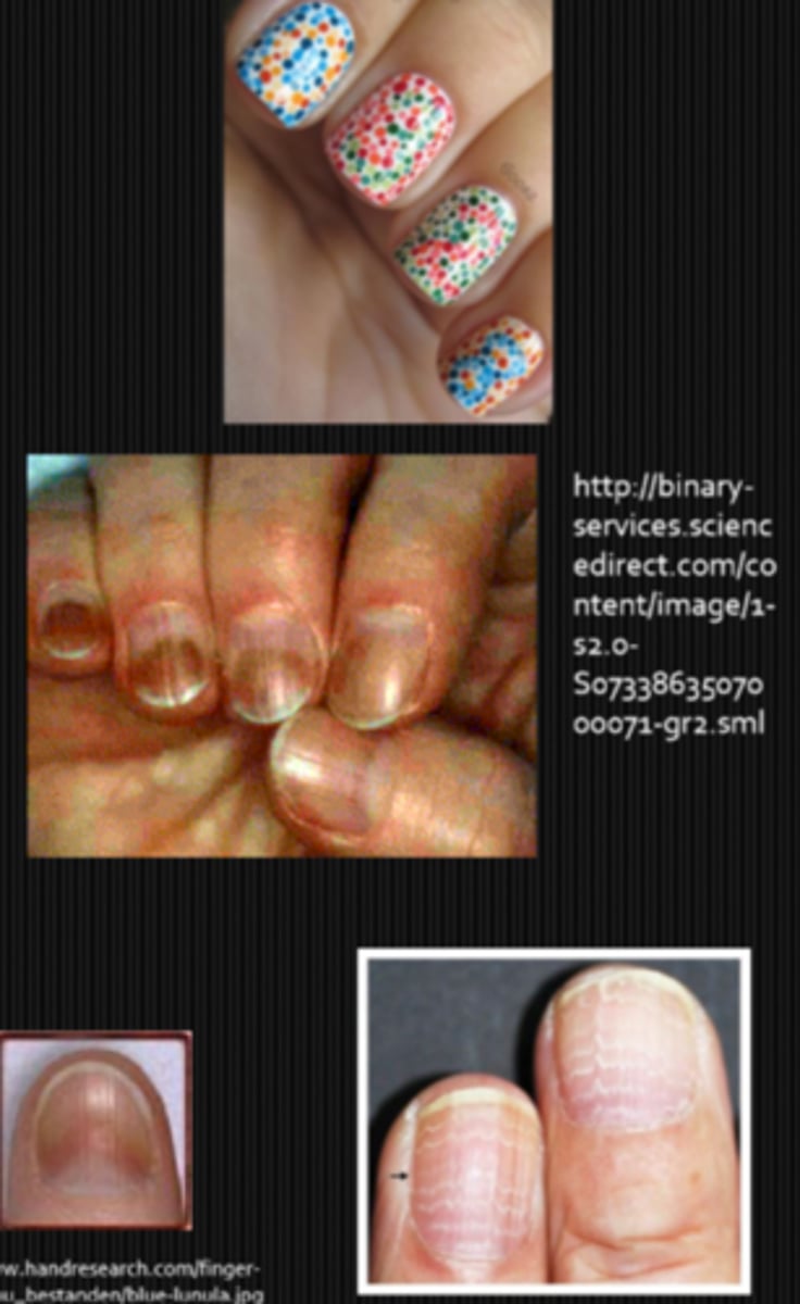<p>nail polish neatly applied or messy?</p><p>subungual hemorrhages in trichinosis, subacute bacterial endocarditis</p><p>azure lunula = Wilson's disease (hepatolenticular degen)</p><p>Beau's lines = white lines on nails due to poisioning, toxicity, nutritional problems</p>