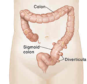 <p>Abnormal side pockets in hollow structures such as the intestines, sigmoid colon, and duodenum</p>