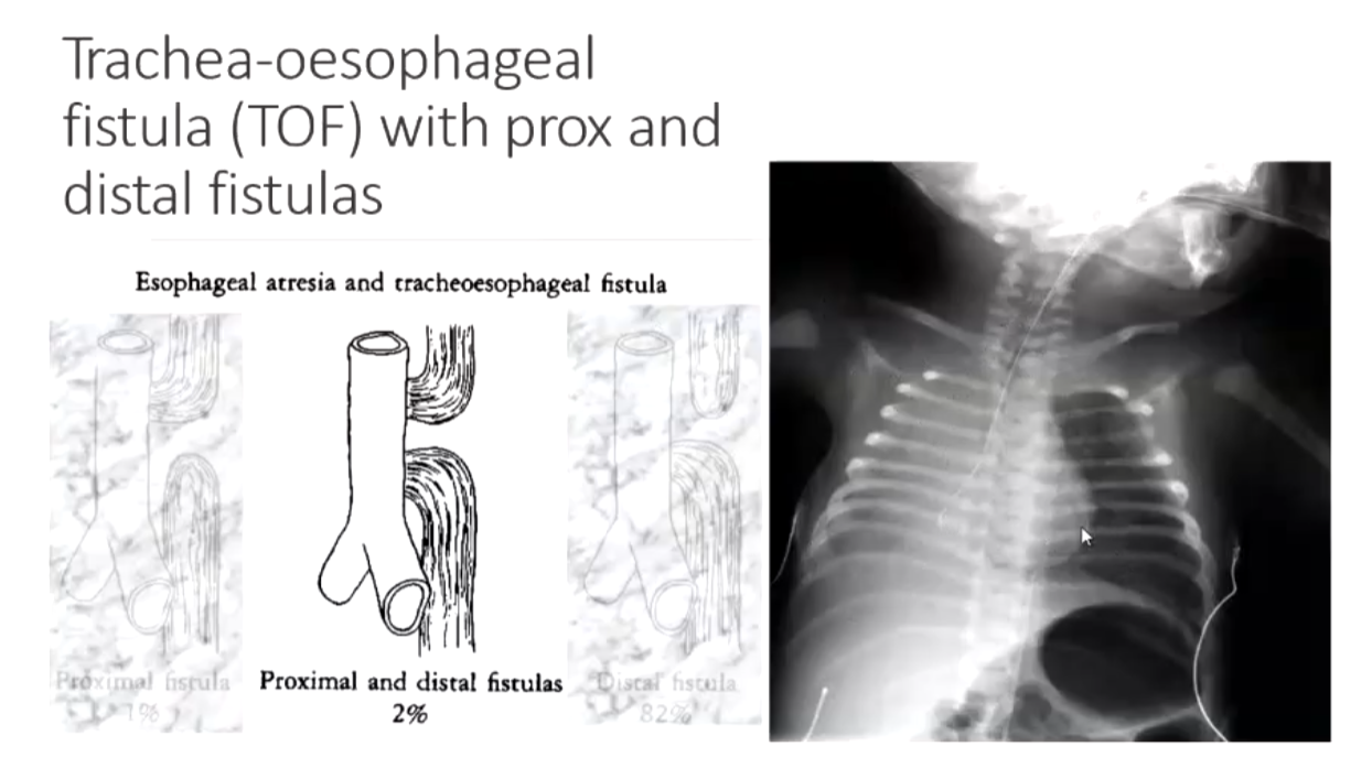 Tube going into lungs and not stomach