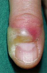 <p>= red, swollen, tender inflammation around the nails</p><ul><li><p>most common nail complaint</p></li><li><p>acute = bacterial infection</p><ul><li><p>chronic = fungal infection from a break in the cuticle</p></li></ul></li></ul>