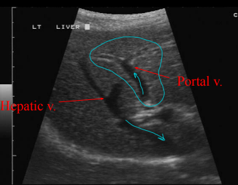 <ul><li><p>Medium level, rough, homogeneous, “<u>salt-and-pepper</u>” echogenicity</p></li><li><p><strong>S&gt;L&gt;K (SLinKy) : brightness descending order </strong></p></li><li><p><strong>Prominent, tapering vessels</strong></p></li><li><p>Smooth margins</p></li><li><p>Intra-Hepatic Vasculature</p><ul><li><p><strong>Portal veins: drain, white walls</strong> </p><ul><li><p><strong>Nutrient rich, deoxygenated blood</strong> from <u>intestines to liver&nbsp;</u></p></li><li><p>Anechoic tapering tubes with hyperechoic walls</p></li></ul></li><li><p><strong>Hepatic veins: drains </strong></p><ul><li><p><strong>Deoxygenated blood</strong> from liver to<u> cava to right heart</u></p></li><li><p>Anechoic tapering tubes with walls you can’t see</p></li></ul></li><li><p><strong>Hepatic arteries</strong></p><ul><li><p><strong>Oxygenated blood</strong> that<u> supplies liver</u> parenchyma</p></li><li><p><strong>Not seen at all</strong></p></li></ul></li></ul></li><li><p>Extra-Hepatic Vasculature</p><ul><li><p><u>Portal vein</u></p><ul><li><p>flaccid, anechoic tube</p></li><li><p><u>ventral and medial to the caudal vena cava</u></p></li></ul></li><li><p><u>Caudal vena cava</u></p><ul><li><p>flaccid, anechoic tube</p></li><li><p><u>dorsal and slightly to the right of midline</u></p></li><li><p>can trace into and through diaphragm</p></li></ul></li></ul></li></ul><p></p>